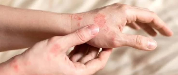 Skin Allergy Treatment