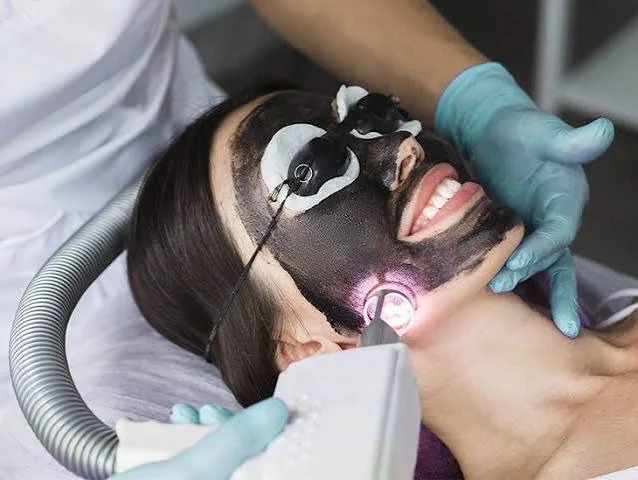 Carbon Laser Peel Treatment