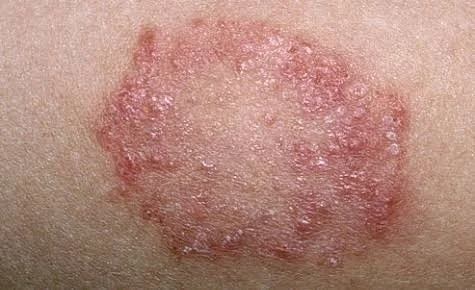 Fungal Skin Infection Care
