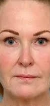 Laser Scar Resurfacing Before