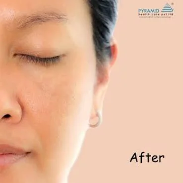 Pigmentation and Spot Removal Treatment