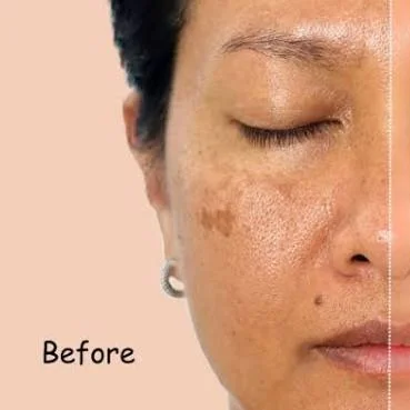 Pigmentation Treatment Before