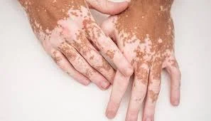 Vitiligo Clinical Treatment