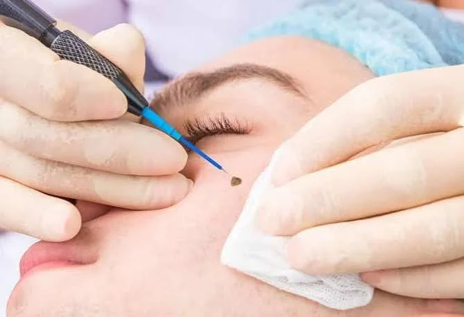 Wart and Mole Removal